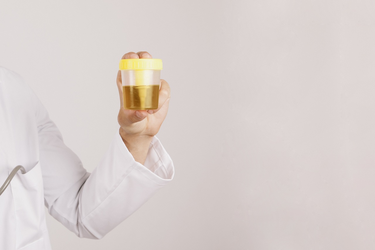 Close up of a doctor holding up a jar filled with a urine sample