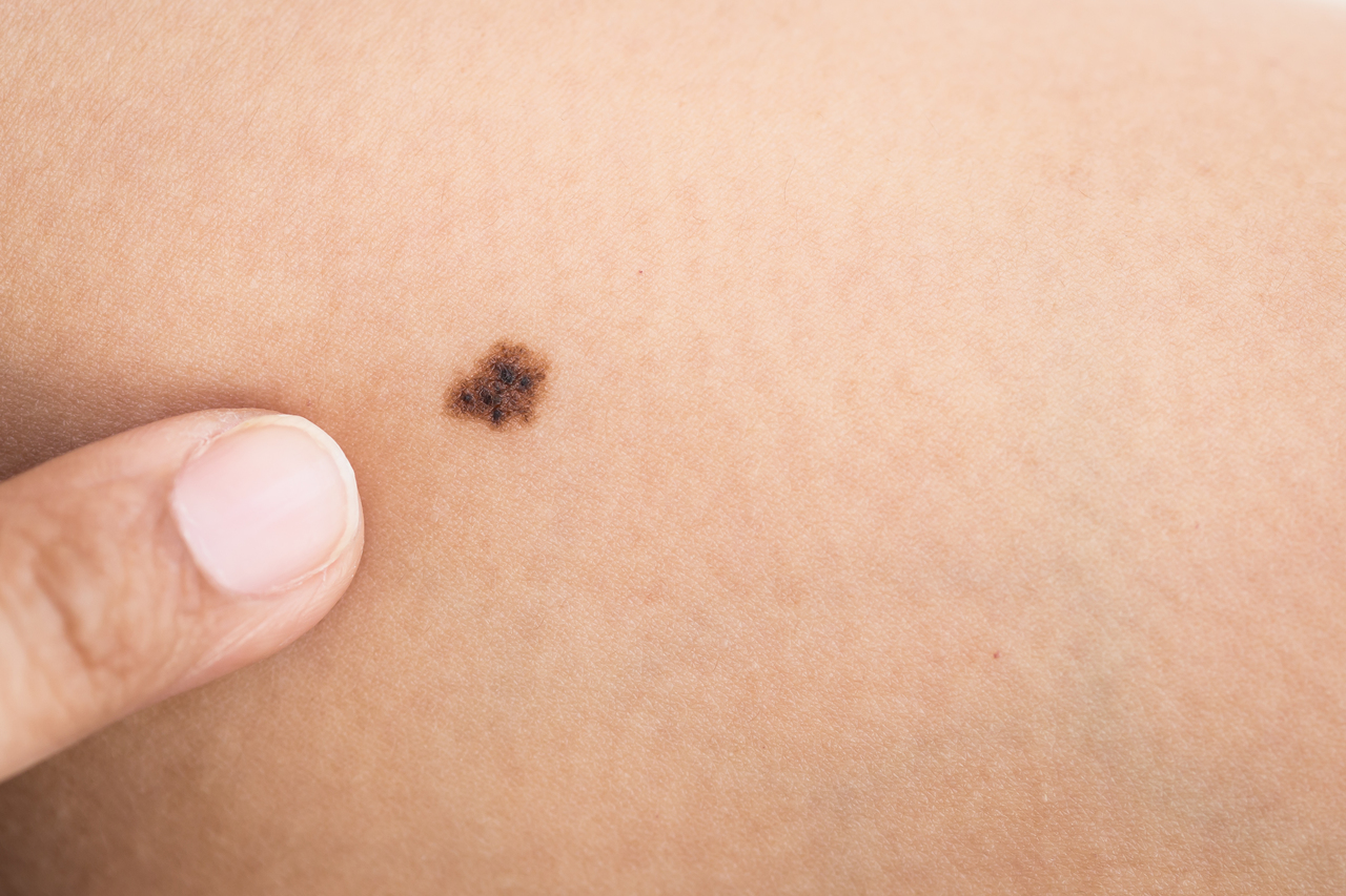 A mole with melanoma