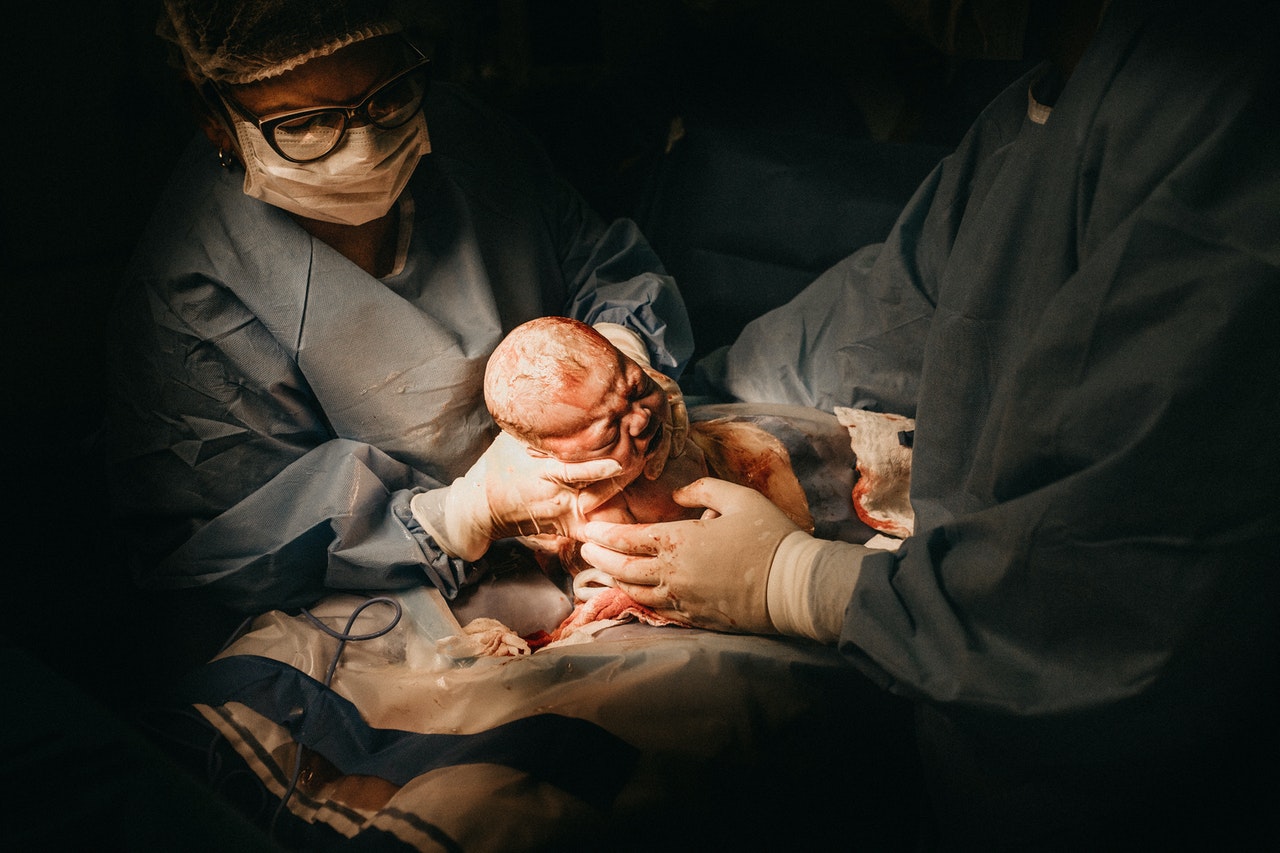 A cesarean delivery